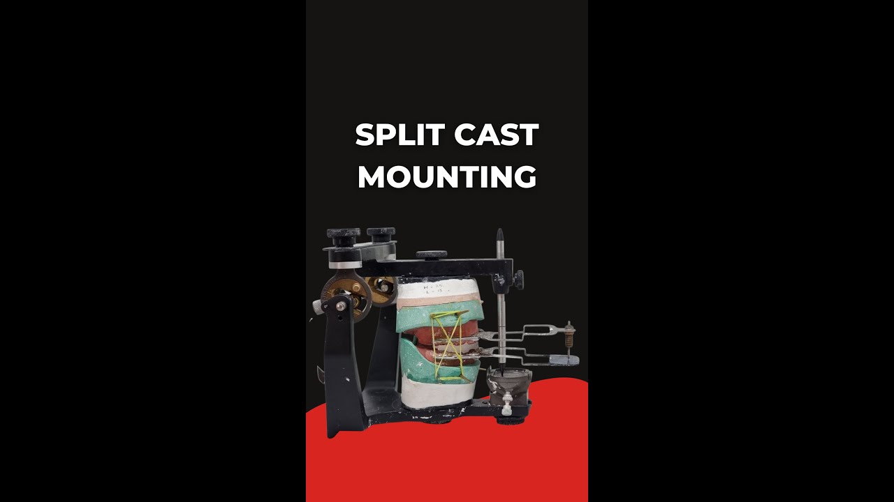 Split Cast Mounting in Complete Dentures
